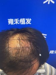 -雍禾植发全国连锁