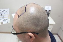 点击看大图 -大麦微针植发丨全国连锁