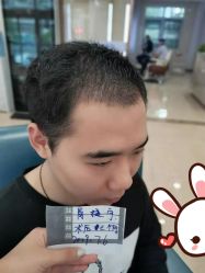 点击看大图 -大麦微针植发丨全国连锁