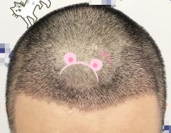 -大麦微针植发全国连锁