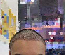 -大麦微针植发丨全国连锁