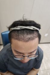-大麦微针植发全国连锁