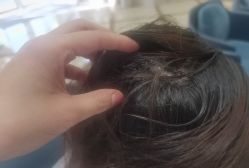 点击看大图 -碧莲盛·不剃发植发
