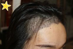 -大麦微针植发丨全国连锁