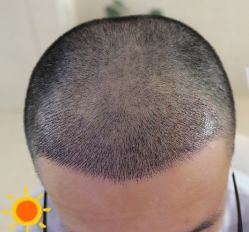 -大麦微针植发丨全国连锁