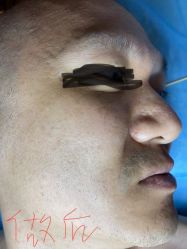 -爱莎扁平疣·汗管瘤·斑痣中心
