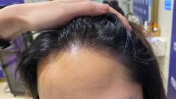 -碧莲盛·不剃发植发