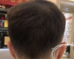 -大麦微针植发全国连锁