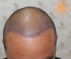 -大麦微针植发丨全国连锁