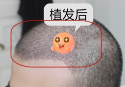 -大麦微针植发全国连锁