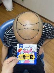 体验前-大麦微针植发全国连锁