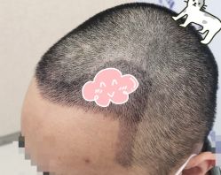 -大麦微针植发全国连锁