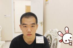 -大麦微针植发丨全国连锁