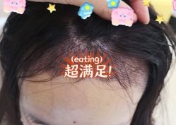 -大麦微针植发全国连锁