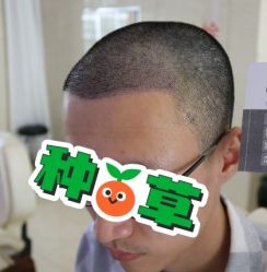 -大麦微针植发丨全国连锁
