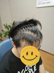 -大麦微针植发全国连锁