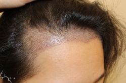 -大麦微针植发丨全国连锁