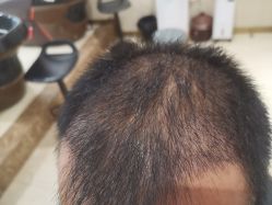 -碧莲盛·不剃发植发