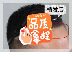 -大麦微针植发全国连锁