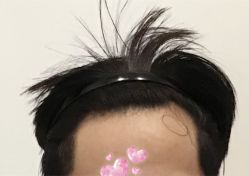 -大麦微针植发全国连锁
