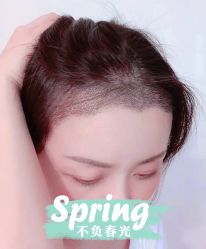 体验后-大麦微针植发全国连锁