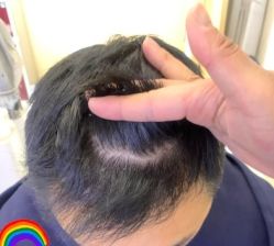 -大麦微针植发丨全国连锁