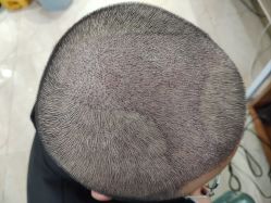 -碧莲盛·不剃发植发