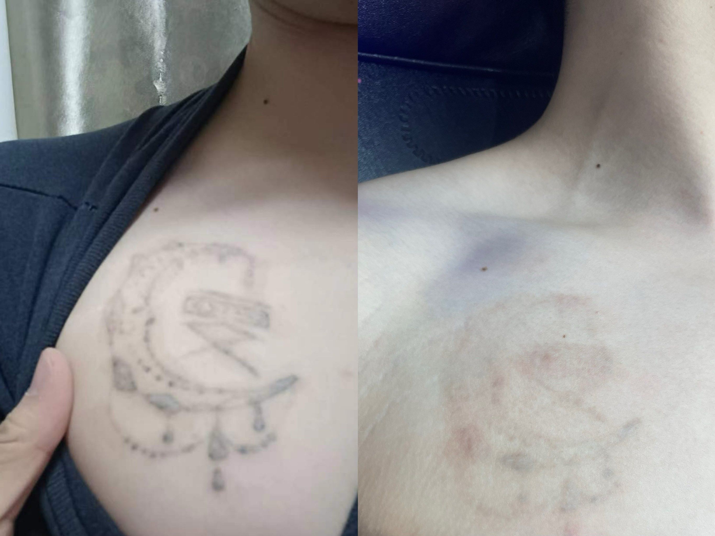 清洗记录,福州洗纹身