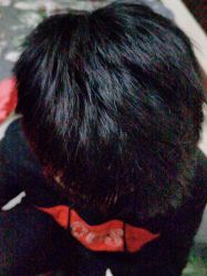 -碧莲盛·不剃发植发