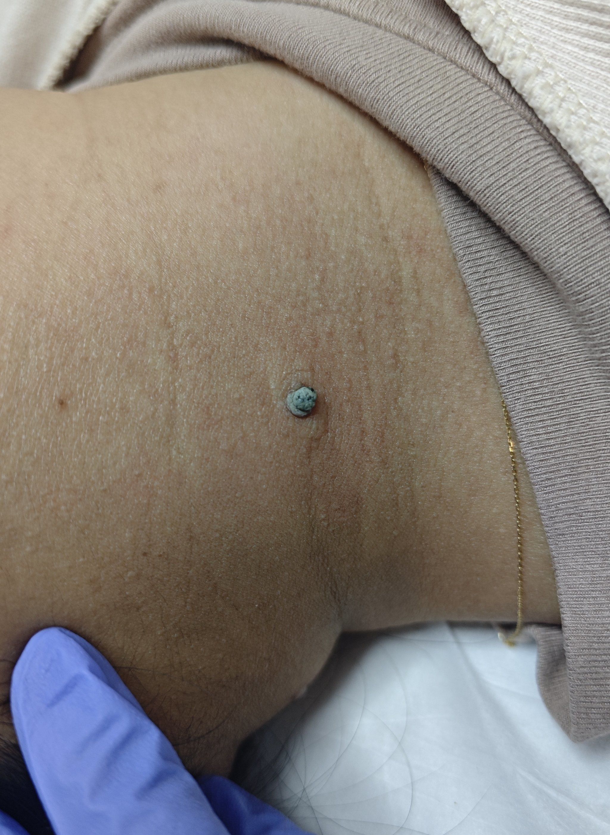 脖子上长个大黑瘤