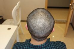 -大麦微针植发丨全国连锁