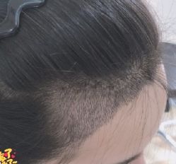 -大麦微针植发丨全国连锁