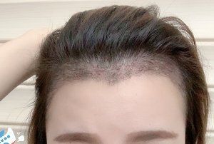 -大麦微针植发丨全国连锁