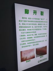 -德哥灰指甲脚气甲沟炎跖疣护理