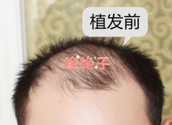 -大麦微针植发全国连锁