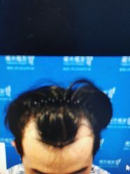 体验前-雍禾植发全国连锁