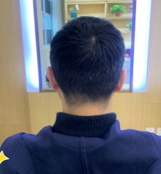 -大麦微针植发丨全国连锁
