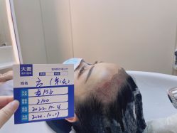 -大麦微针植发全国连锁