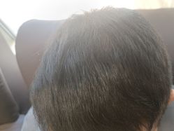 -碧莲盛·不剃发植发