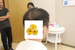 -大麦微针植发丨全国连锁