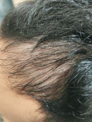 -碧莲盛·不剃发植发