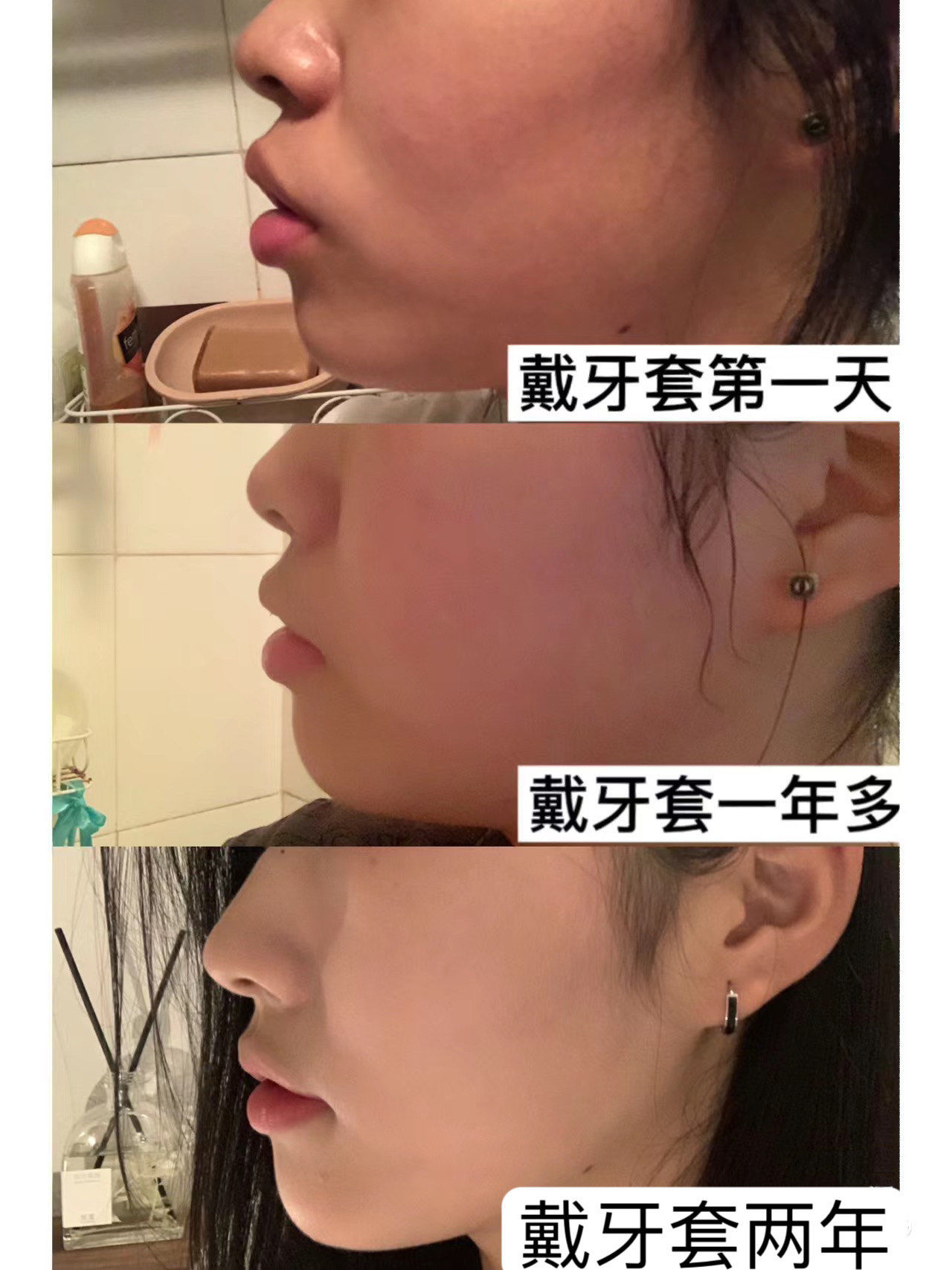 我的矫正对比图分享