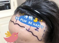 -大麦微针植发全国连锁