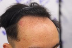 -大麦微针植发丨全国连锁