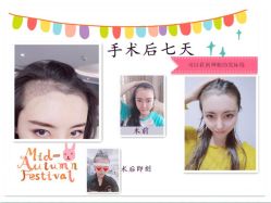 -大麦微针植发全国连锁