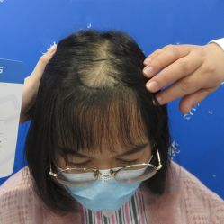 -碧莲盛·不剃发植发