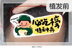 -大麦微针植发全国连锁