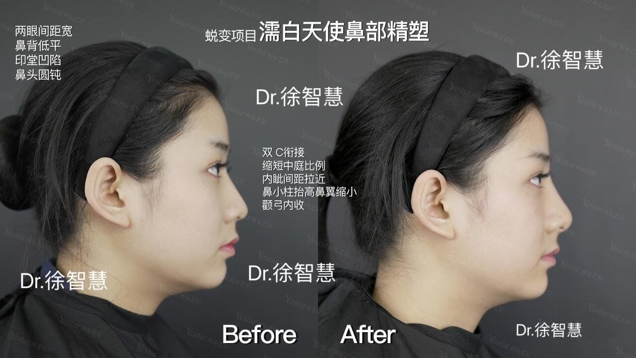 74大鼻头 74宽鼻背的宝子们看过来98
年前想do鼻,又不想动刀