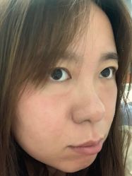 体验后-亿美医疗美容·半岛大超炮官方授权店