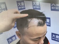 点击看大图 -大麦微针植发丨全国连锁